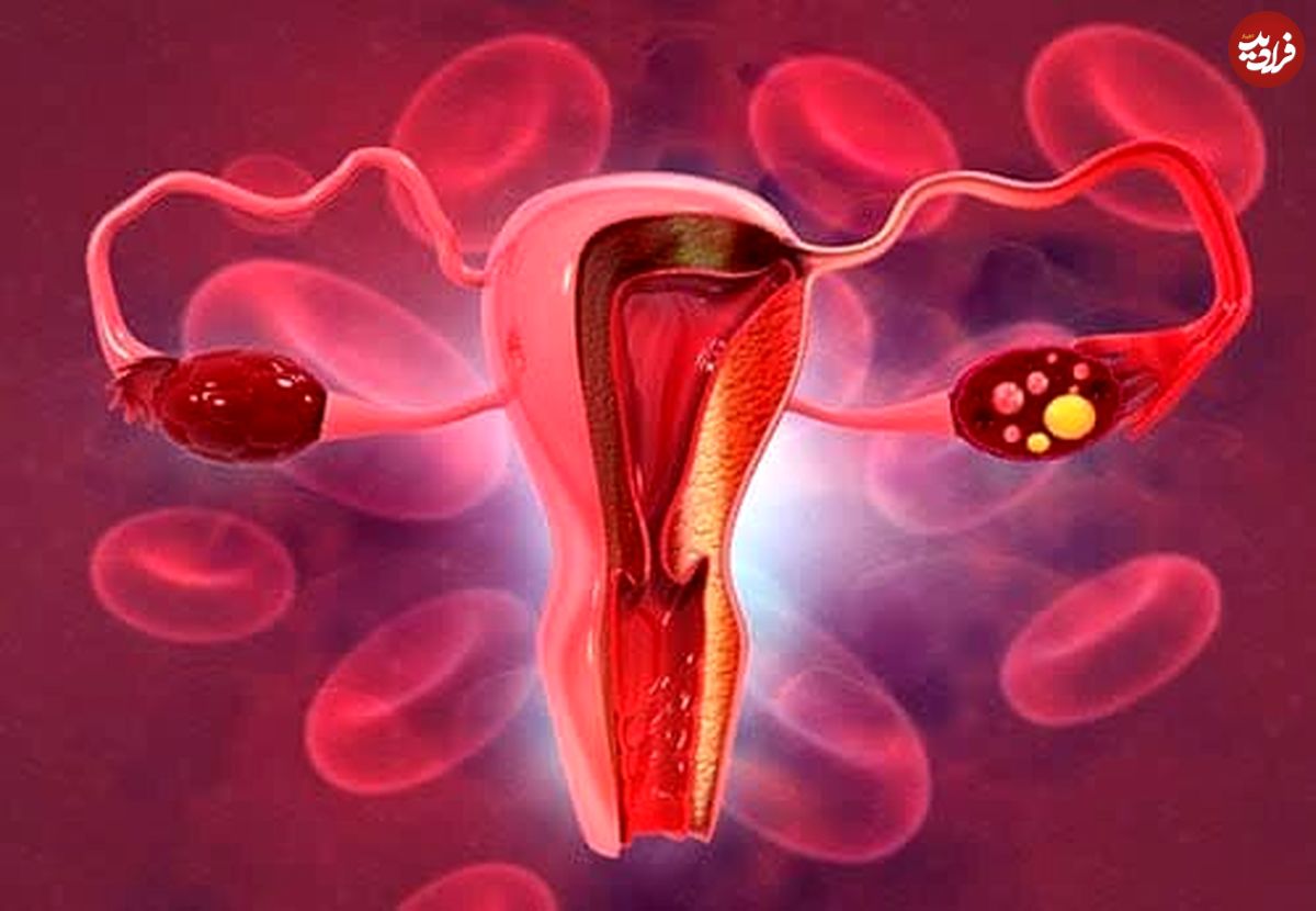 علل، علائم و راه‌های پیشگیری از سرطان دهانه رحم را بشناسید