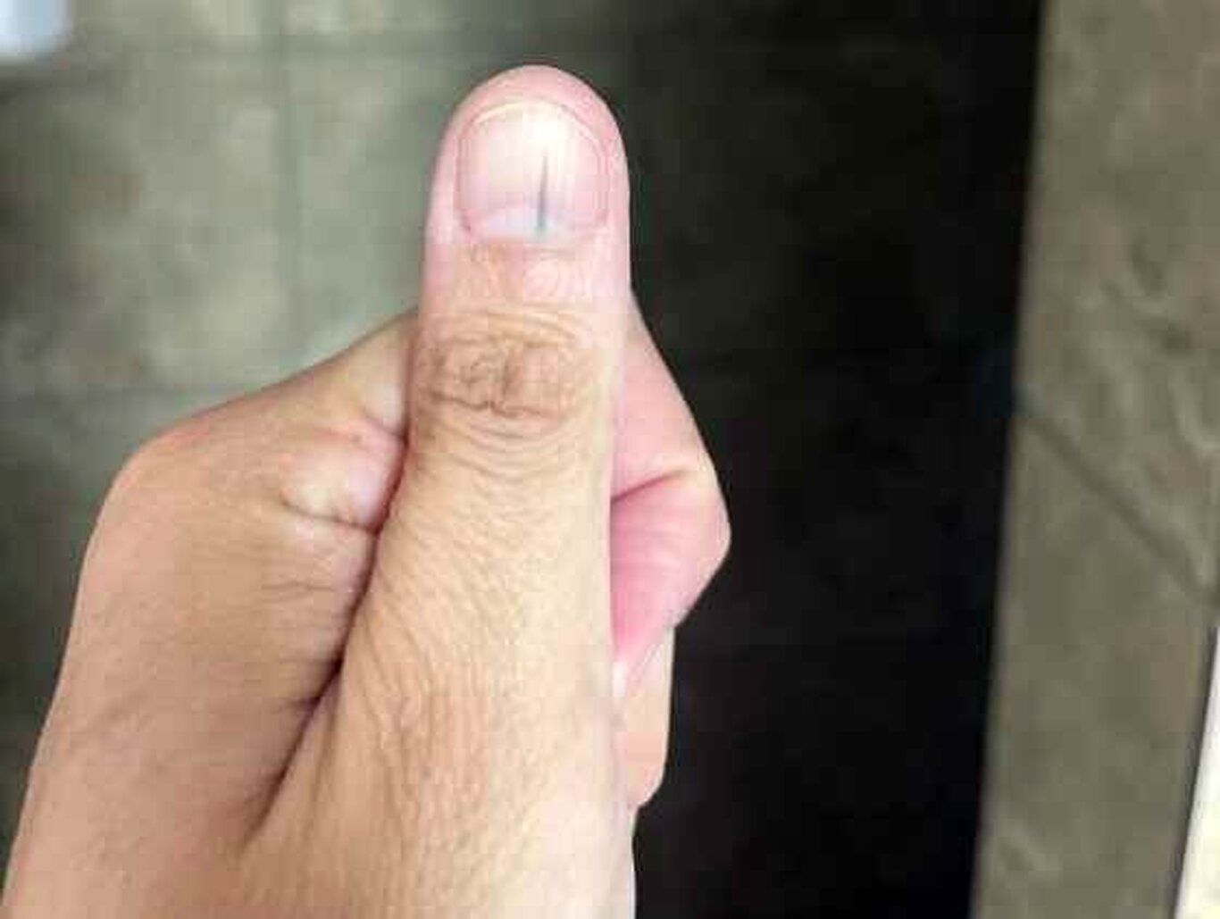 (تصاویر) این خط عجیب روی ناخن، نشانه سرطان پوست است!