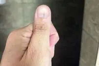 (تصاویر) این خط عجیب روی ناخن، نشانه سرطان پوست است!