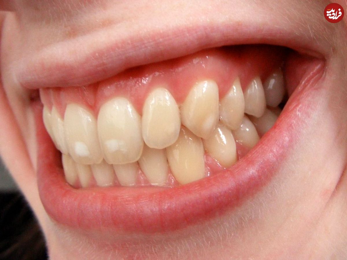 علت ایجاد لکه‌های سفید روی دندان