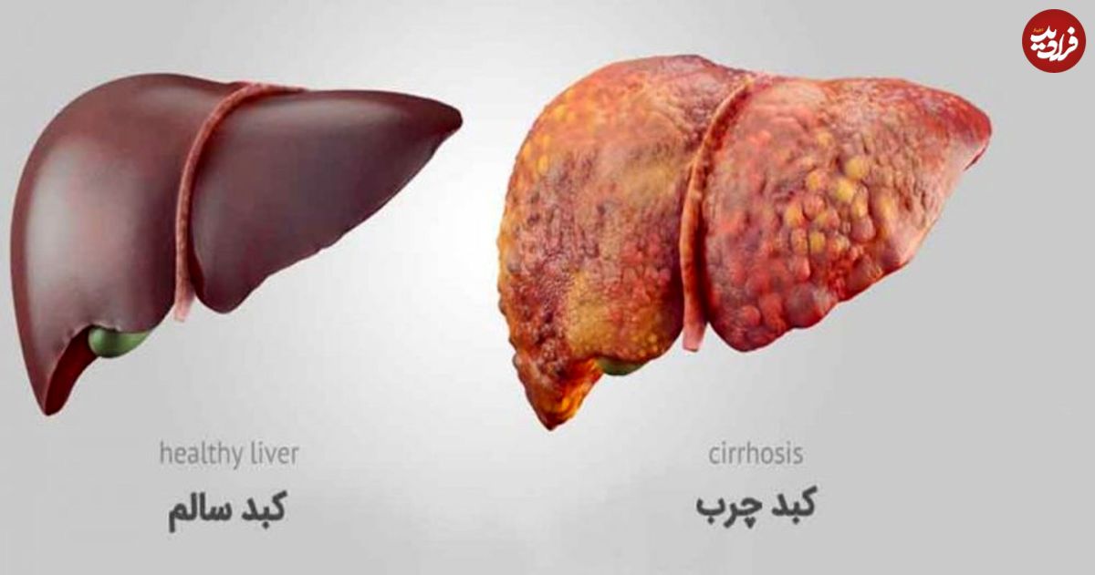 کبد چرب دارید؟! این مطلب را بخوانید
