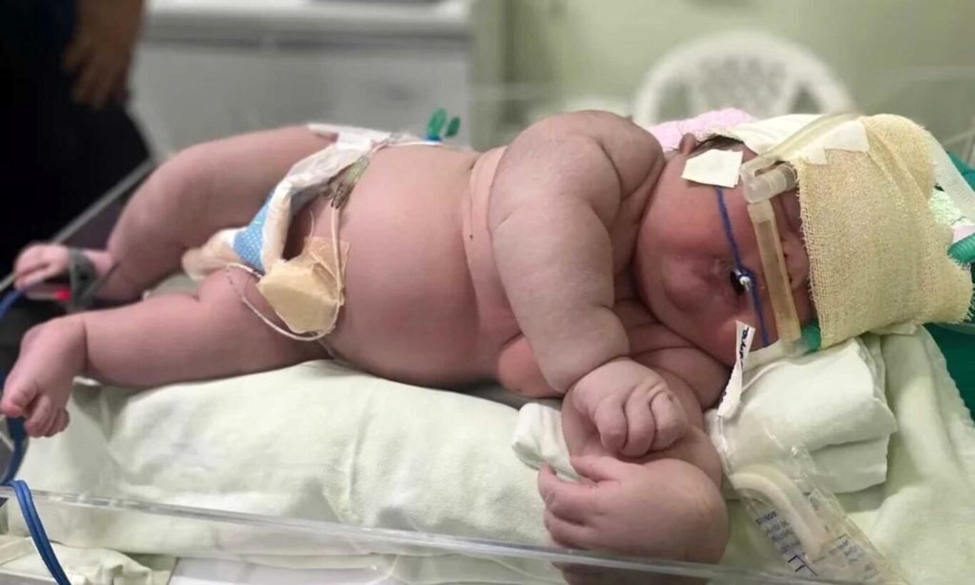 (عکس) تولد نوزادی با ۷ کیلوگرمی وزن و ۶۰ سانتیمتر قد در برزیل