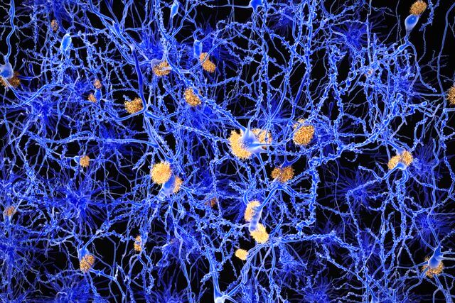 کشف نشانه اولیه آلزایمر در مغز