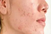 جوش زدن در هر قسمت از صورت نشانه کدام بیماری است؟