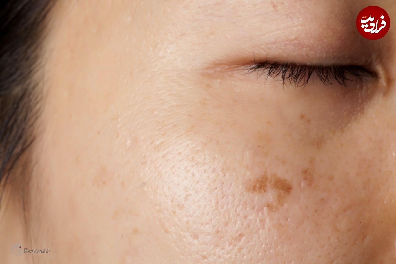 درمان لکه‌های قهوه‌ای پوست؛ علت لکه‌های قهوه‌ای پوست چیست؟