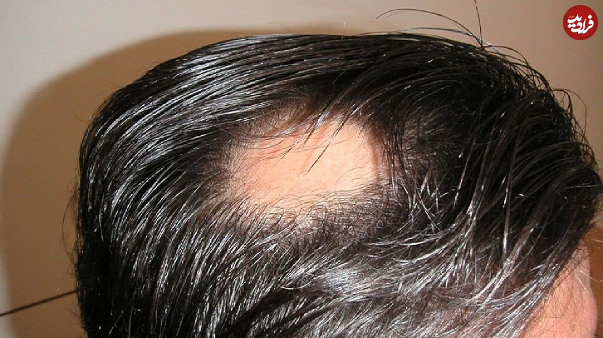 علت ریزش سکه‌ای مو چیست؟
