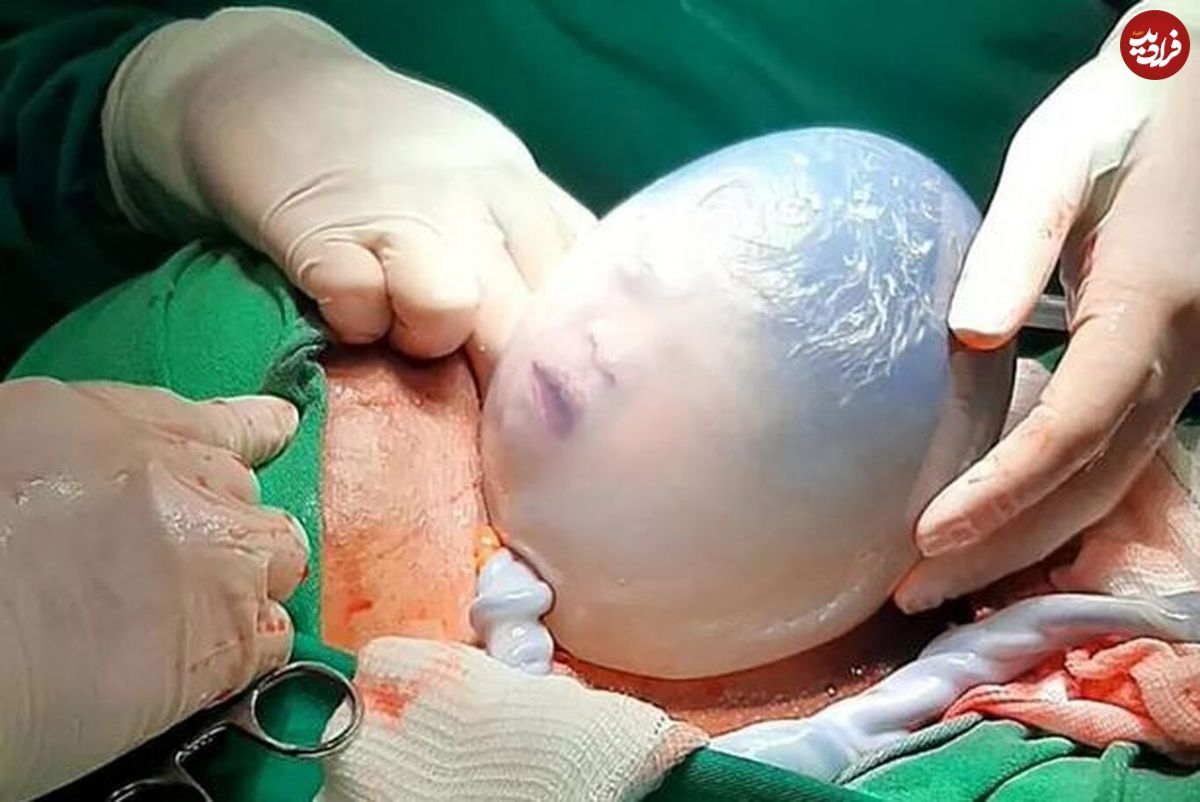 (عکس) در اتفاقی نادر، یک نوزاد با کیسه آب سالم متولد شد!
