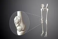 درمان سرطان استخوان با مینی استخوان‌های انسانی