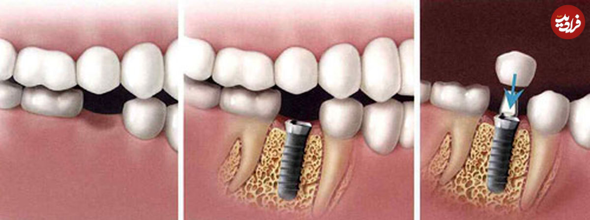 ایمپلنت؛ بهترین جایگزین دندان های از دست رفته