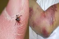 مرگ زن مشکوک به تب کریمه در شیراز