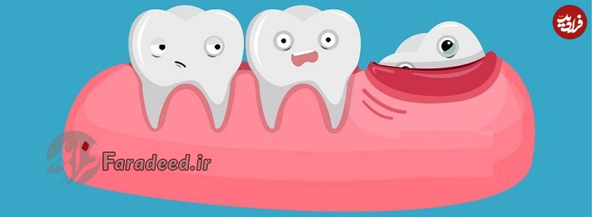 ۲۴ ساعت پس از کشیدن دندان عقل چه اتفاقی می‌افتد؟