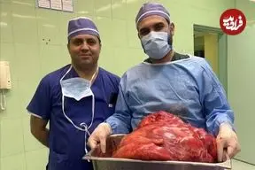 خارج کردن توده ۲۳ کیلویی از شکم خانم تبریزی